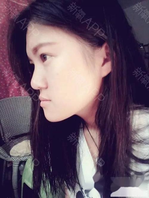 19岁地包天患者,请大家给一些建议