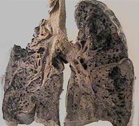 矽肺是尘肺中最为严重的一种职业病,它的影响面广,是我国最常见的一种