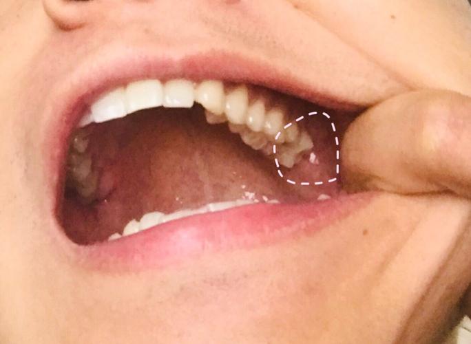 想这样的智齿要拔除吗?