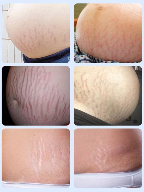 都会在孕期生长妊娠纹,而它其实是一种发生于孕期的腹部皮肤膨胀纹,在