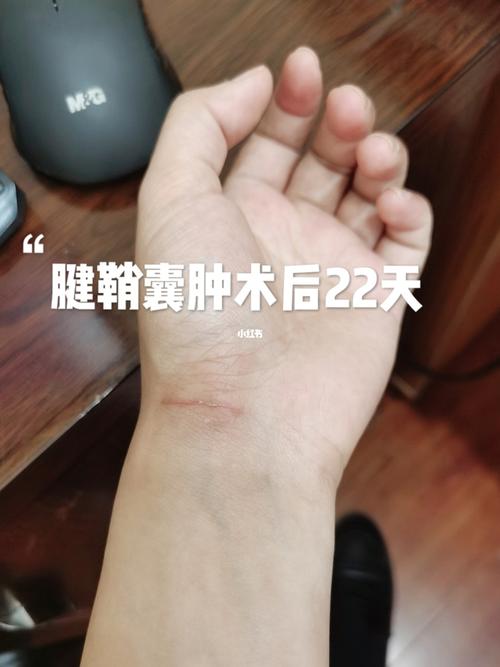 腱鞘囊肿术后恢复