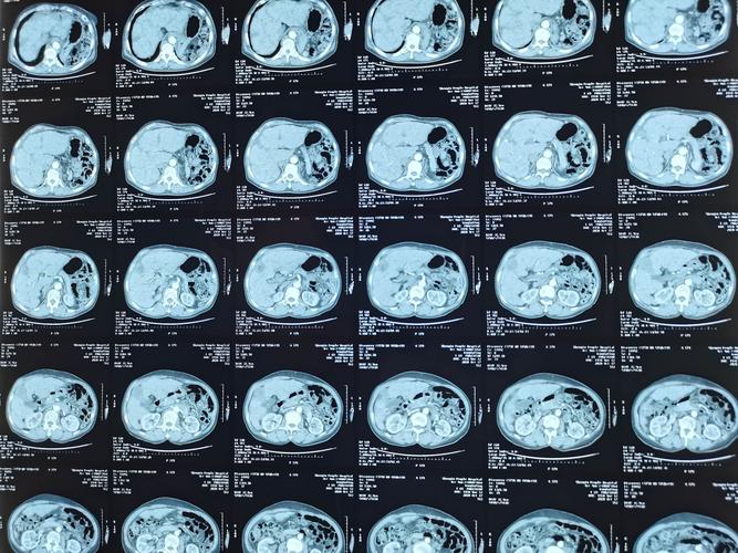 增强ct:肝细胞肝癌消融术后,各期无增强,无复发,无残留,达到根治性