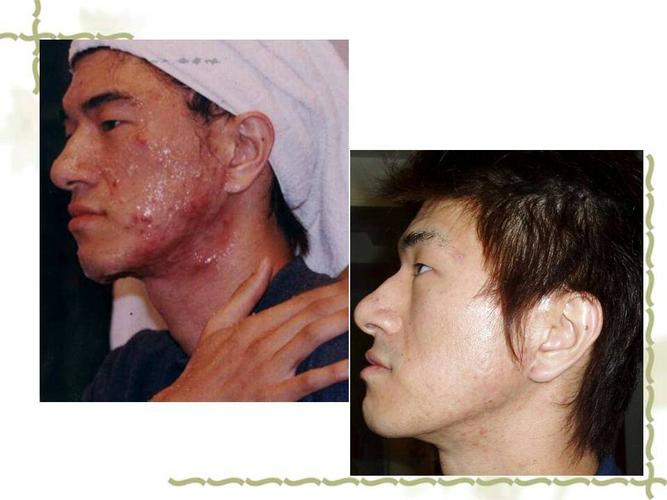 发水痘第四天了去医院看了医生开了阿昔洛韦片说吃药就可以今天起来