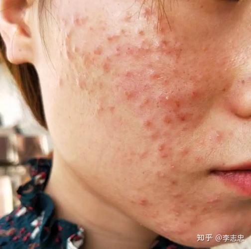 丘疹型痤疮症状