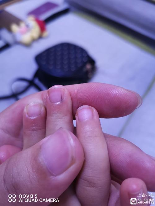 可有人知道小孩指甲长这个黑线咋的了