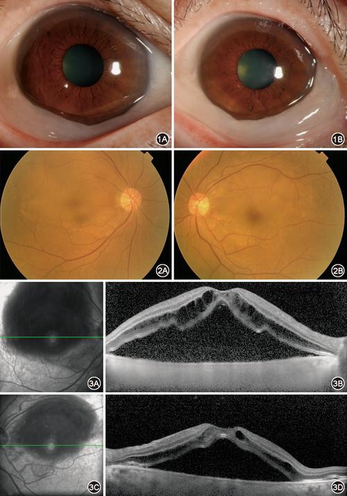 可见球结膜水肿,未见明显充血1a示右眼;1b示左眼 图2 肾病综合征伴