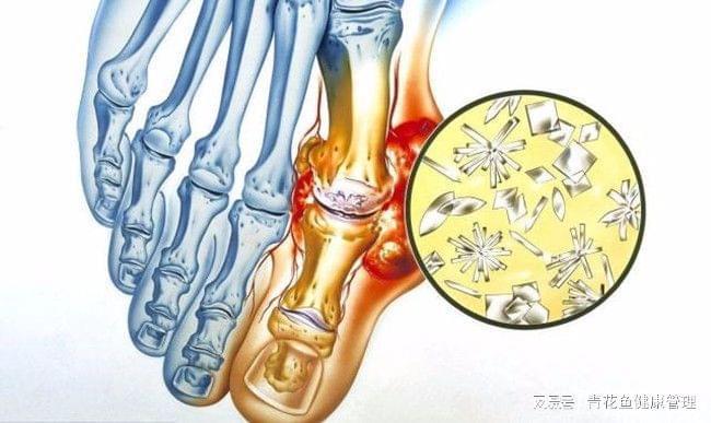 怎么消除痛风石