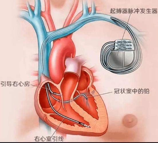 健教丨心脏起搏器的那些事儿.