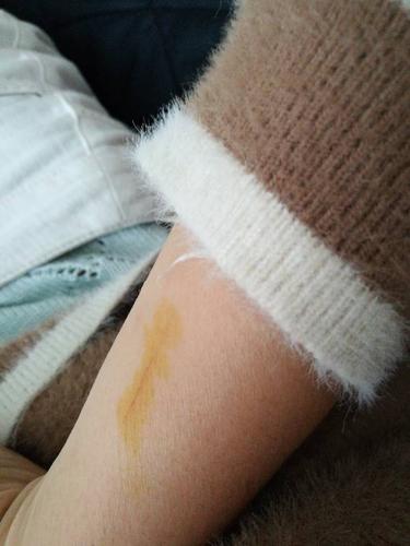 我被两个半月狗抓了红印,这算破皮吗?要去医院吗?