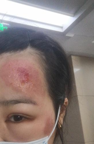 鼻炎好了,湿疹犯了