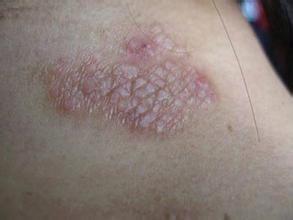 神经性皮炎治疗方法有哪些,用中药治疗有效吗?