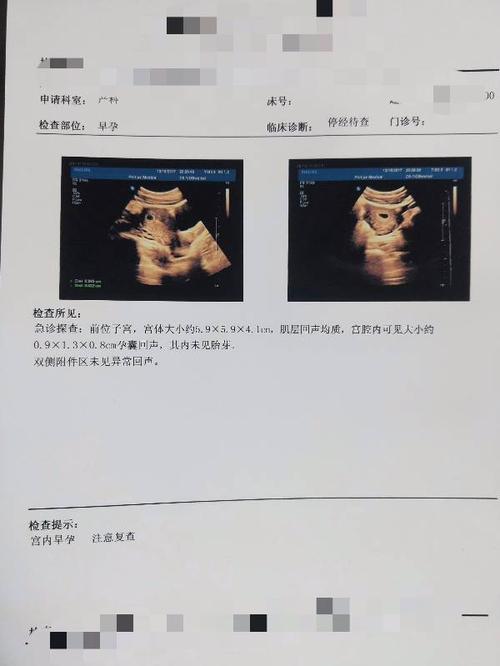 怀孕40多天照的,是不是宫外孕,这个片子能看出来什么