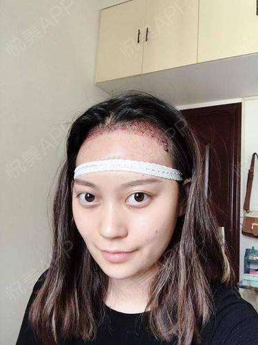 鬓角种植术后1天_发际线种植术后1天_头发种植术后1天_面部毛发种植术