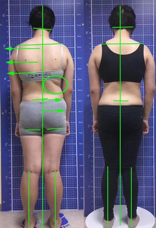 13岁身高已经178cm,假性的脊柱侧弯