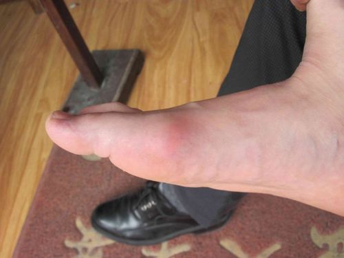 这也是一例很典型的痛风发作