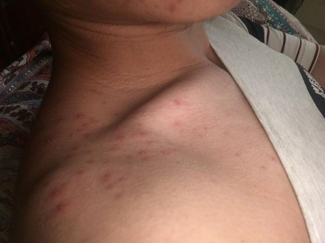 请问大家喝酒完了以后身上长了很多痘痘 一片一片得