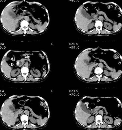 大夫,我的急性胰腺炎已经好了,快过春节了,能不能少喝