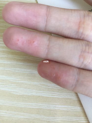 手上长水泡泡,谁也有这种情况?_皮肤病_化学_洗发膏