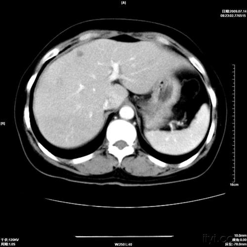 肝ct平扫 强化,帮忙看下
