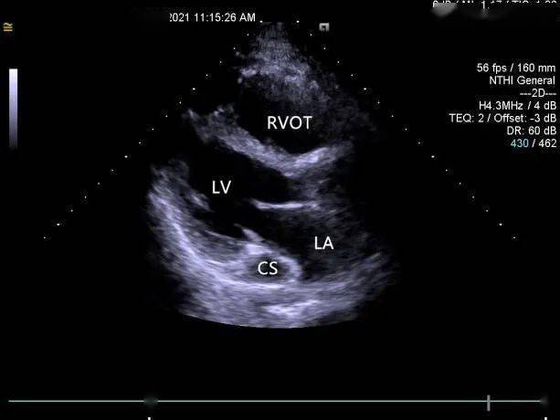 一个病例引发的思考 —— 冠状静脉窦扩张的诊断思路