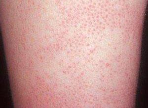 毛囊角栓是由于毛囊皮脂腺管之开口处有角化现象,形成所谓的角栓,而