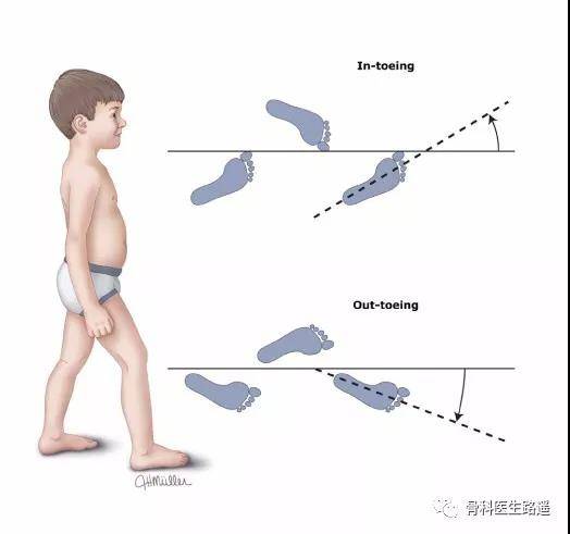 "内八字脚",专业叫足内旋,是指行走时足趾尖朝向中线;"外八字脚"