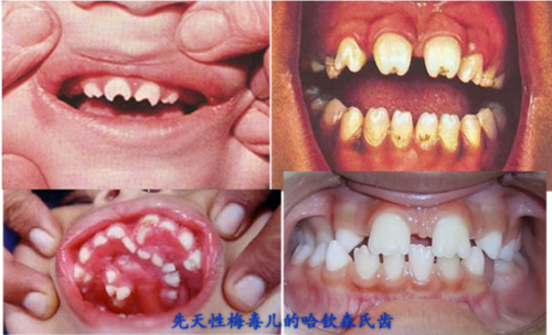 传染病对妊娠的影响(3):梅毒