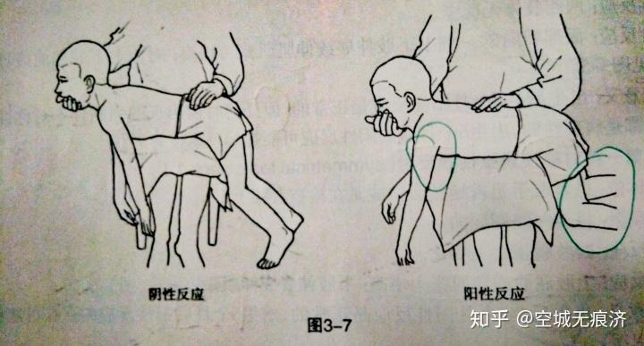 3. 紧张性迷路反射:由头部位置改变诱发出来的