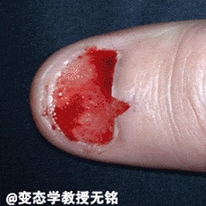 拔掉指甲后的指甲重生过程～～(via 变态学教授无铭)