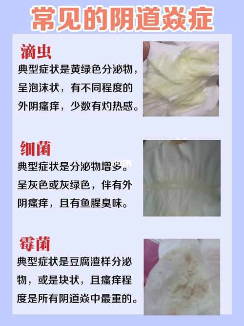 白带不正常得重视,不然可能就会成焱症!