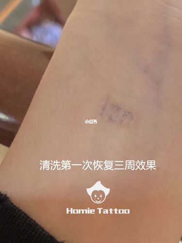 『皮秒洗纹身』洗纹身一次效果对比图_纹身_广州攻略