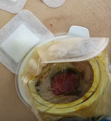 腹腔镜下直肠癌经括约肌间切除术(isr)