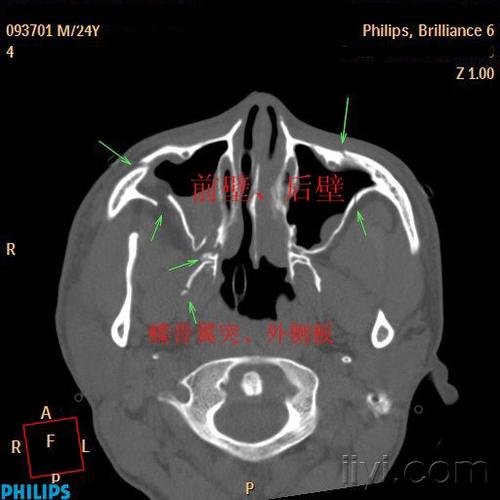 眼,鼻,上颌窦等的骨折,要慢慢的,小心的看喔