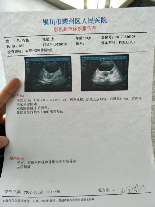 盆腔积液2.3厘米严重吗.