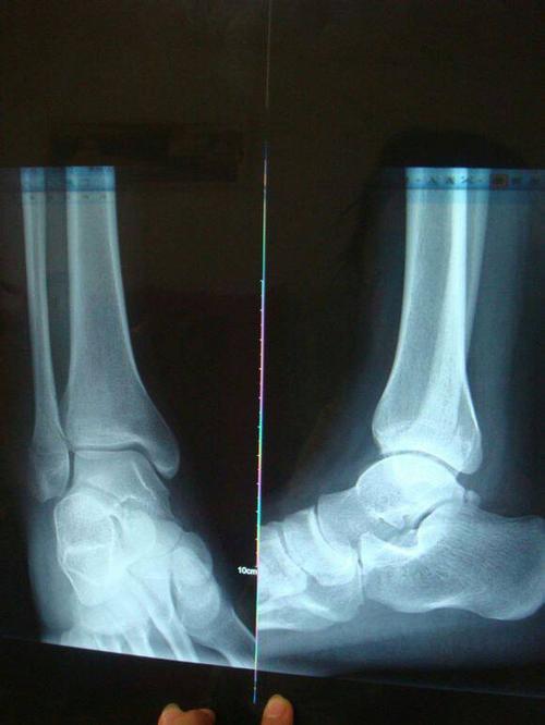 问:这样的脚踝扭伤严重吗,骨折了吗