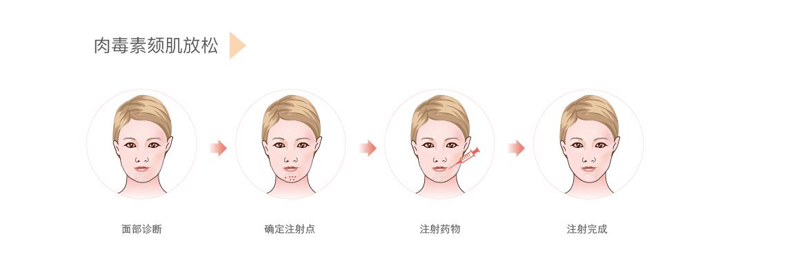 肉毒素颏肌放松