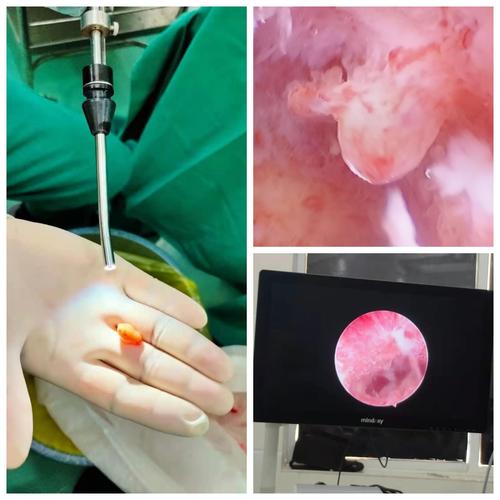 宫腔镜检查发现子宫内膜息肉,冷刀切除子宫内膜息肉!