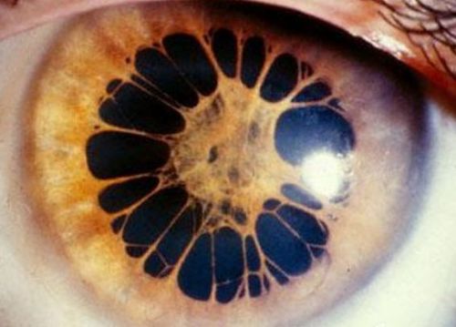 先天性瞳孔残膜