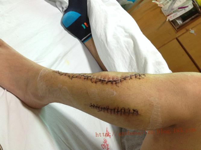 胫腓骨骨折 - 骨伤一组 - 骨 伤 一 组