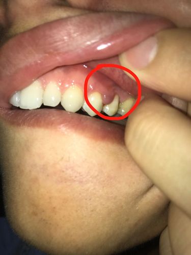 牙龈肿痛两条未见消退,一刷牙碰到就出血,怎么办?吃什么药?