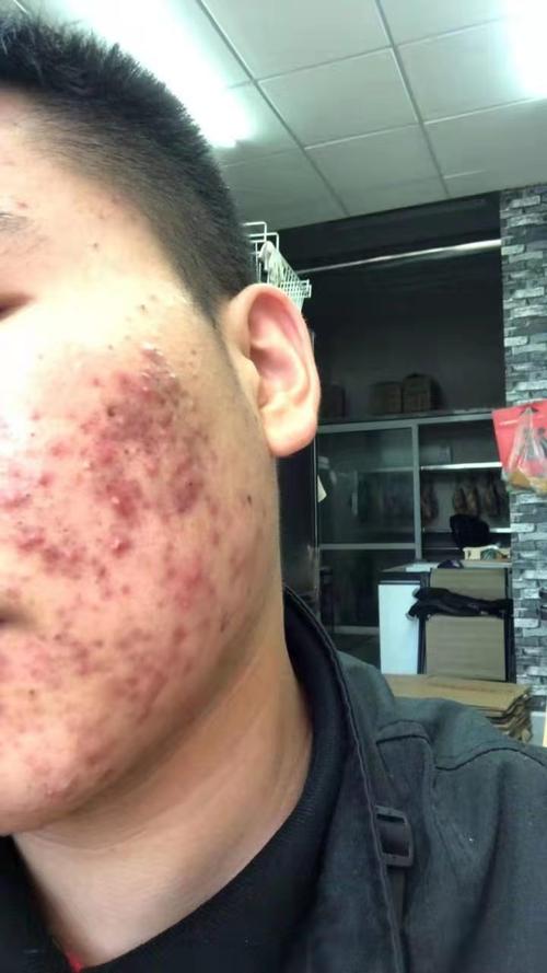 21岁男孩囊肿型痤疮,中药14天后,痘痘明显好转!