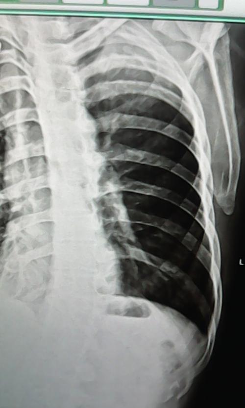 超声入门贴369-----多根肋骨骨折