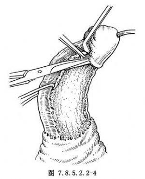 【阴茎海绵体松懈术】阴茎海绵体松懈术手术详细步骤