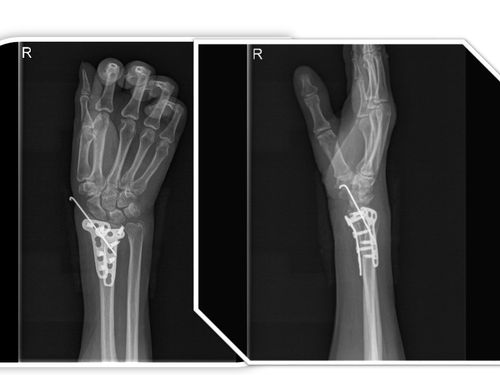 桡骨远端骨折的解剖及手术入路