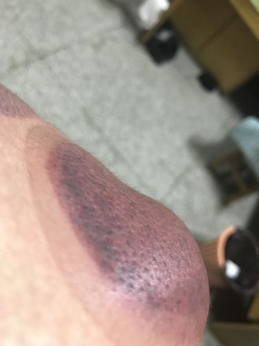 拔罐背部,发黑发紫是什么症状,湿气重?