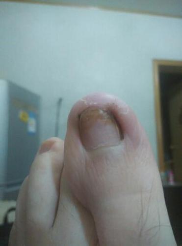大脚趾甲沟炎图片