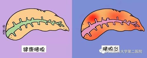 急性胰腺炎～胰腺的自我消化
