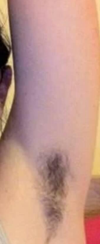 我16岁跳舞的,长腋毛了,上台前没刮,马上开始表演了,怎么办