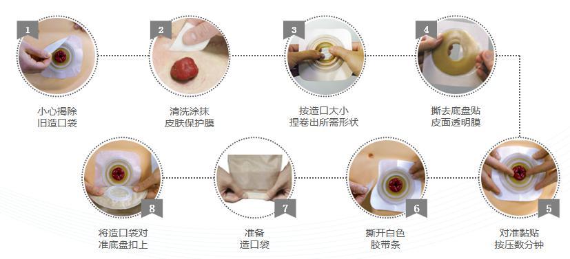 肠道造口的家庭护理