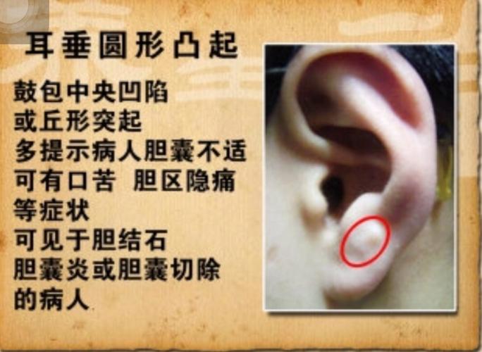 写美篇另外,我们可以看耳垂,从耳朵上诊断冠心病主要是看"冠状沟"